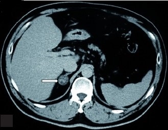 CT Scan - Right Aldosteronoma