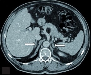 Bilateral Adrenal Hyperplasia