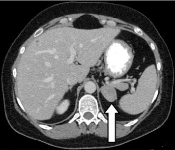 CT scan - Left Adrenal Adenoma