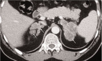 CT scan - Bilateral Adrenal Nodular Hyperplasia