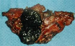 Adrenal Metastasis - Melanoma