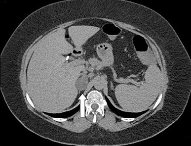 Benign Nonfunctional Adrenal Adenoma - CT