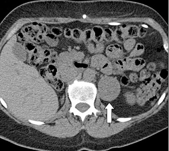 Incidental Functional Pheochromocytoma