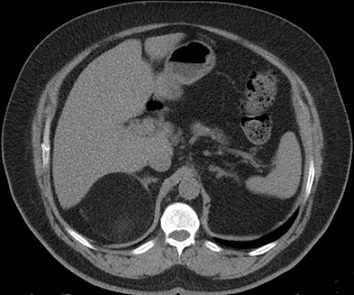 Large Adrenal Myelolipoma - CT