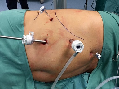 Laparoscopic Right Adrenalectomy Port Placement