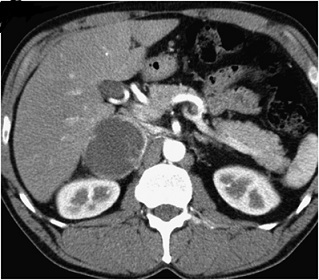 Pheochromocytoma - CT