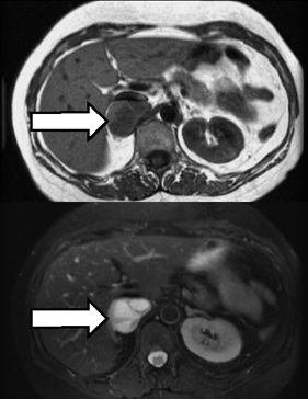 Pheochromocytoma - MRI