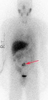 Extra-adrenal Pheochromocytoma - MIBG Scan