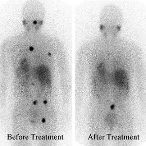 Metastatic Pheochromocytoma Treated with I-MIBG