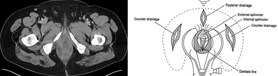 Horseshoe Abscess