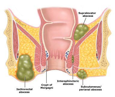 Anorectal Abscesses