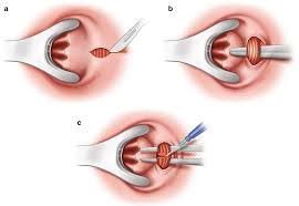 Lateral Internal Sphincterotomy