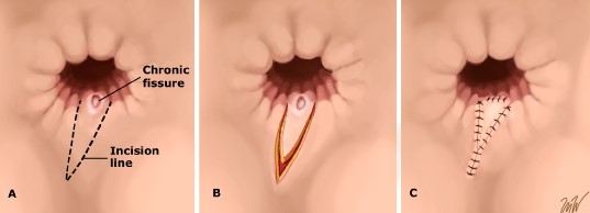 V-Y Advancement Flap for Anal Fissure