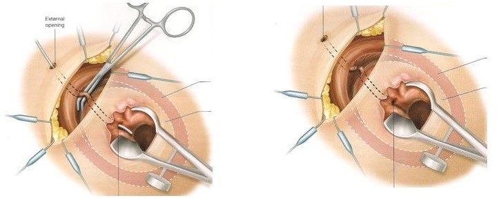 Ligation Intersphincteric fistula Tract (LIFT)