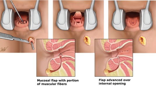 Anorectal Fistula Advancement Flap