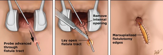 Anorectal Fistulotomy