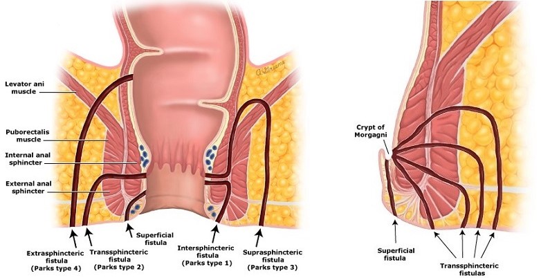 Parks Classification of Anorectal Fistulas