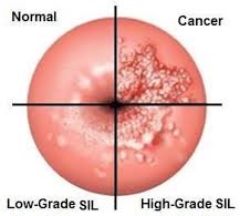 Anal Intraepithelial Lesions