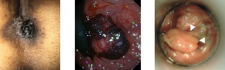 Multiple Anal Melanomas