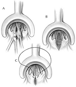 Closed Hemorrhoidectomy