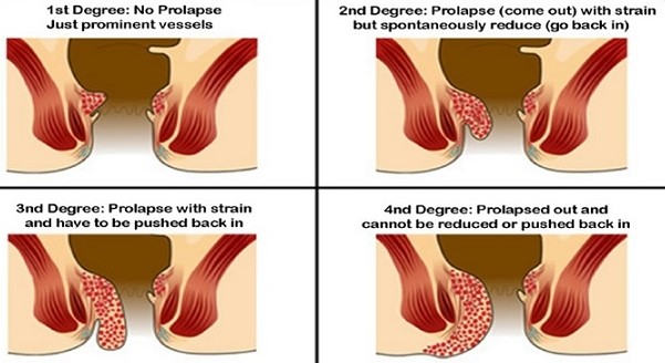 Hemorrhoid Classification