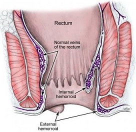 Internal and External Hemorrhoids