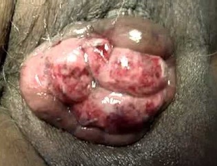 Strangulated Hemorrhoids