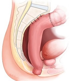 Low Anterior Resection with Rectopexy