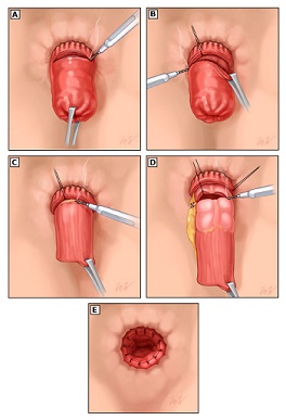 Altemeier Procedure