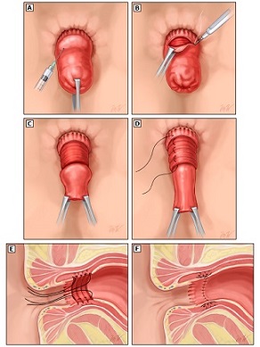 Delorme Procedure