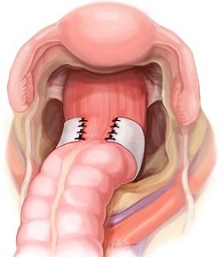 Posterior Mesh Rectopexy