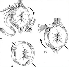 Thiersch Procedure