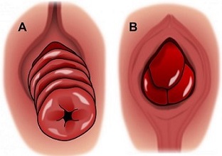 Rectal Prolapse and Prolapsed Hemorrhoids