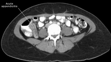 Appendicitis on CT Scan