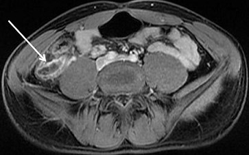 Appendicitis on MRI