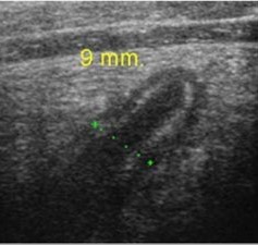 Appendicitis on Ultrasound