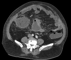 Appendiceal Abscess on CT Scan