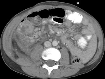 Appendiceal Phlegmon on CT Scan