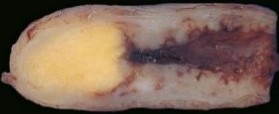 Appendiceal Carcinoid Tumor