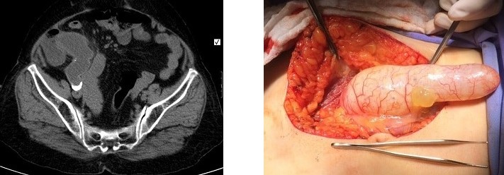 Appendiceal Mucocele:  CT Scan and Operative Finding