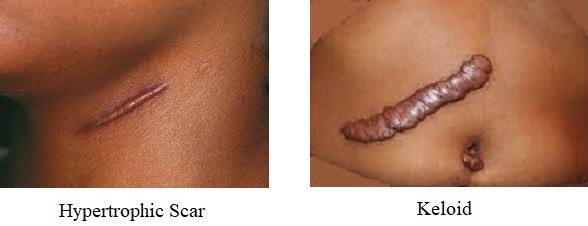 Hyperplastic Scar and Keloid