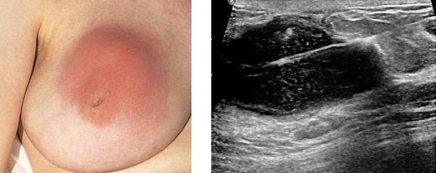 Breast Abscess