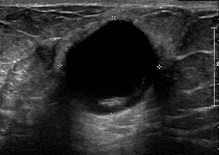 Ultrasound of a Complex Breast Cyst