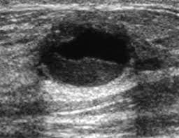 Ultrasound of a Complicated Breast Cyst