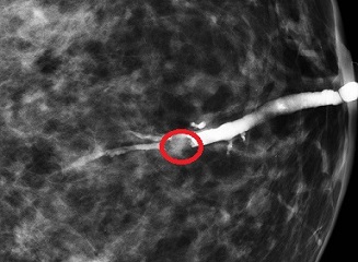 Ductography Revealing an Intraductal Papilloma