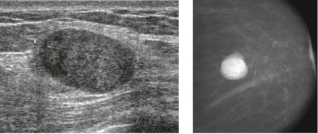 Mammogram and Ultrasound of a Fibroadenoma