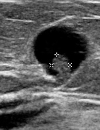 Ultrasound of an Intraductal Papilloma