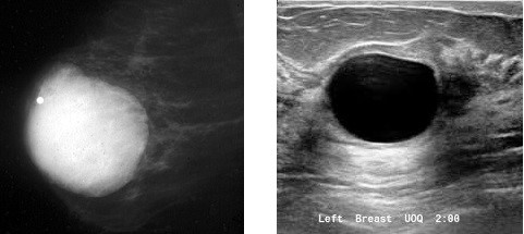 Mammogram and Ultrasound of a Simple Breast Cyst