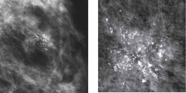 DCIS Microcalcifications