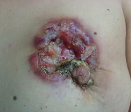 T4 Breast Cancer with Skin Involvement